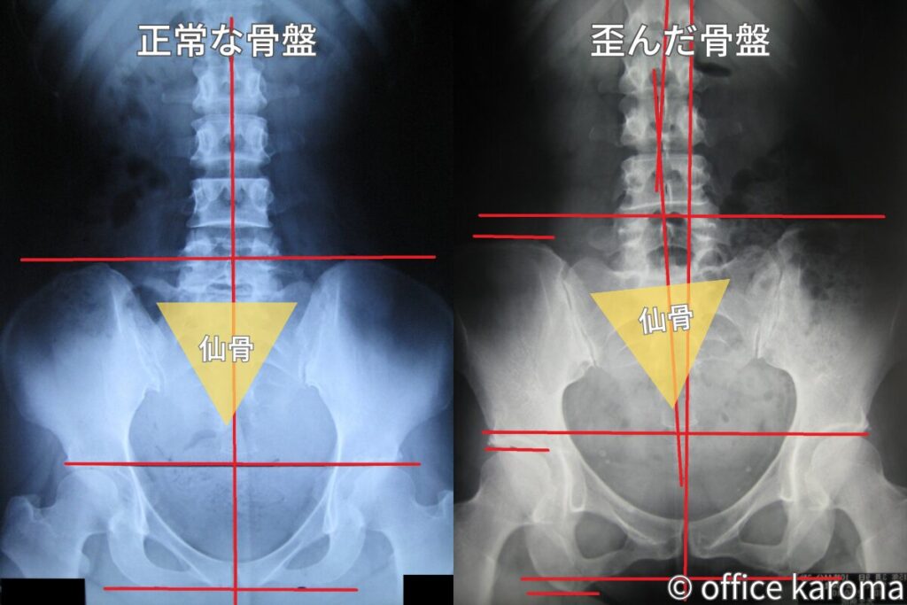 仙骨のレントゲン,骨盤