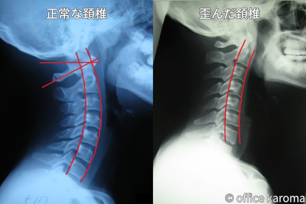 頚椎側面,レントゲン