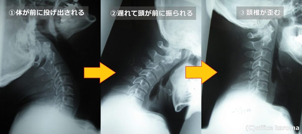 むち打ちの発生メカニズムのレントゲン
