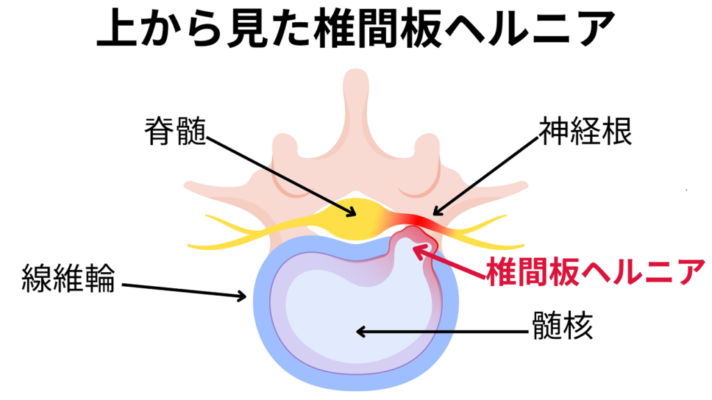 椎間板ヘルニア