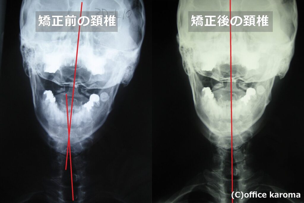 頚椎正面,レントゲン,プレポス