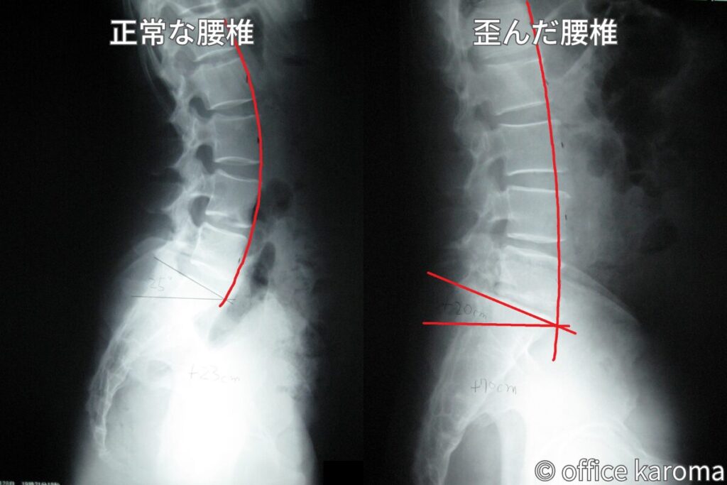 正常な腰椎とカーブがなくなった腰椎