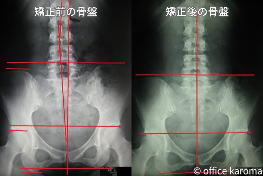 骨盤,プレポス