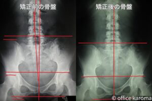 骨盤,プレポス