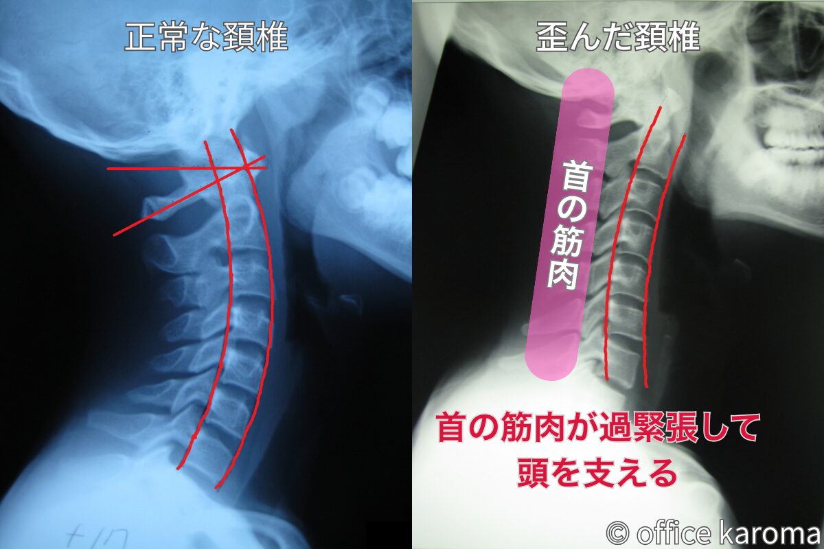 頚椎,緊張型頭痛