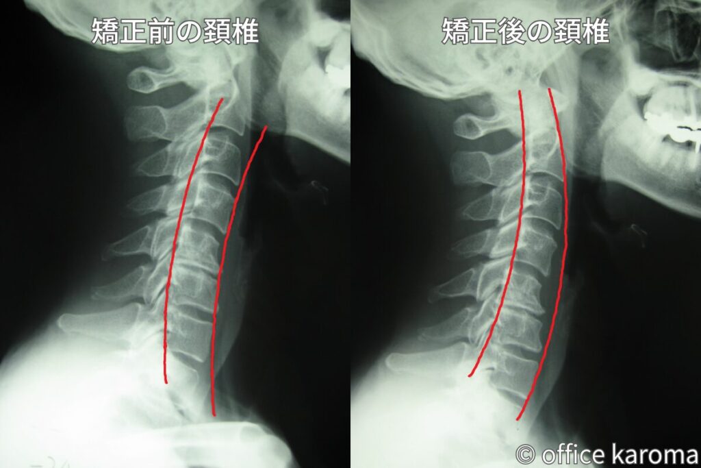 頚椎ヘルニア,preposレントゲン