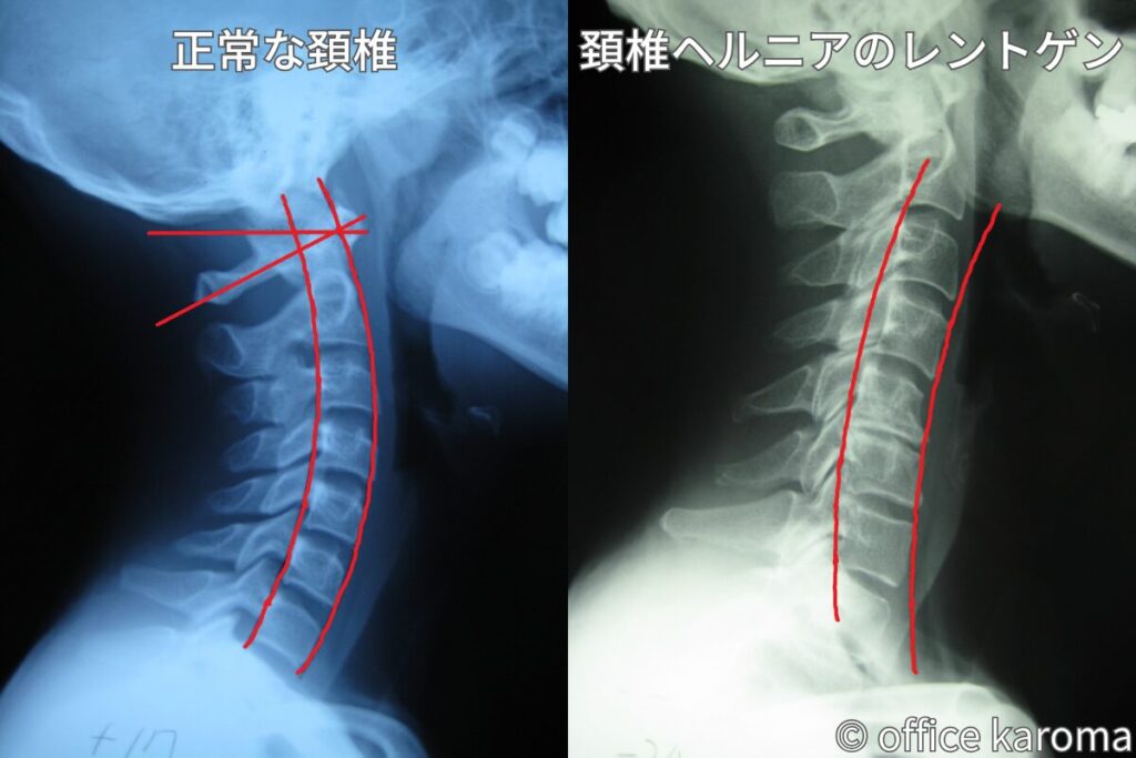 頚椎ヘルニア,再発,レントゲン