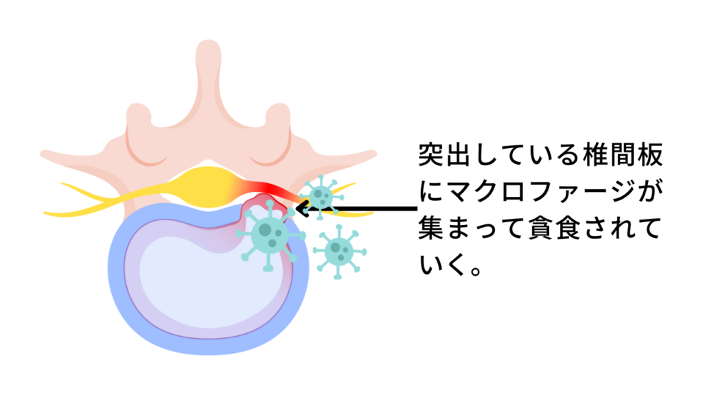 椎間板ヘルニア,自然治癒,マクロファージ