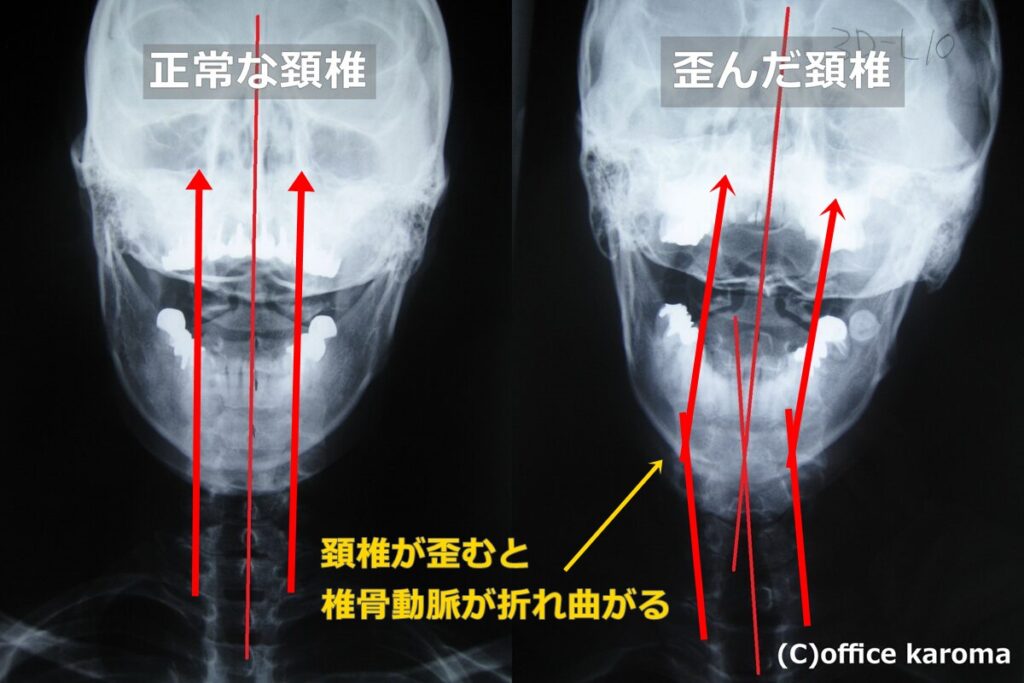 片頭痛,拍動性頭痛,レントゲン,椎骨動脈