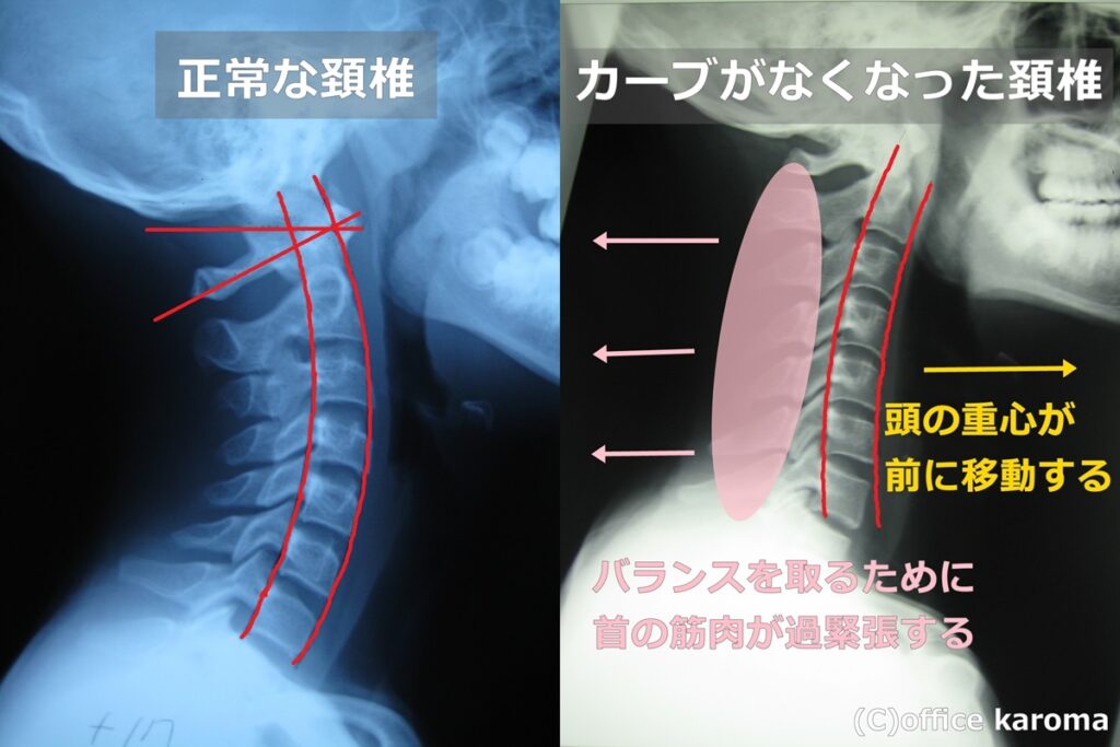 肩こり,首の痛み,ストレートネック,レントゲン