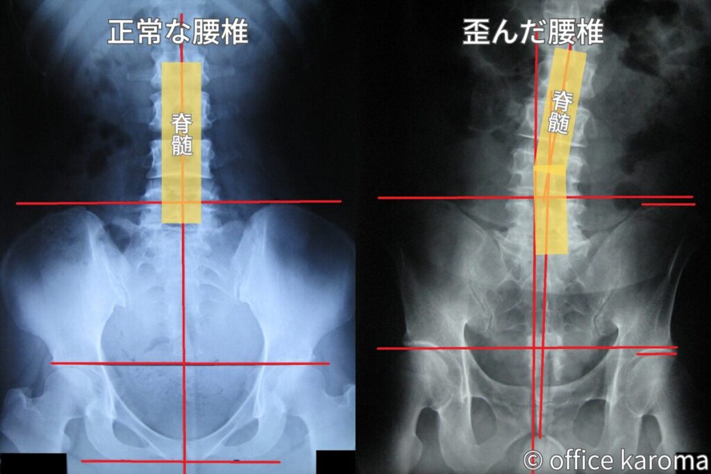 自律神経のレントゲン,腰椎