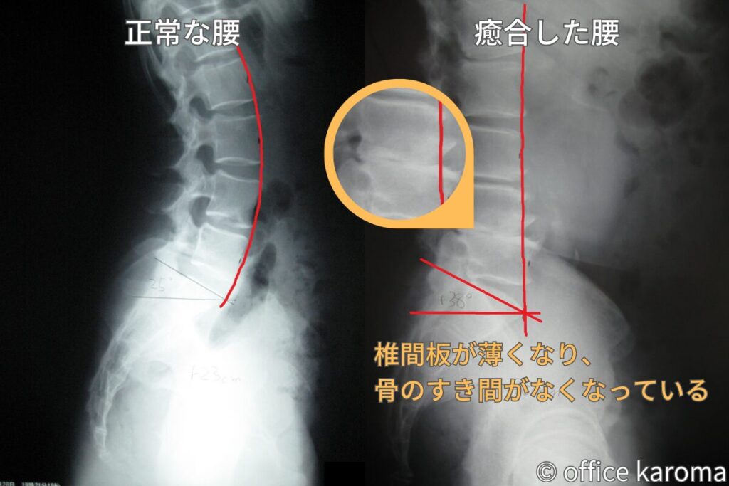 骨のすき間がなくなった腰のレントゲン