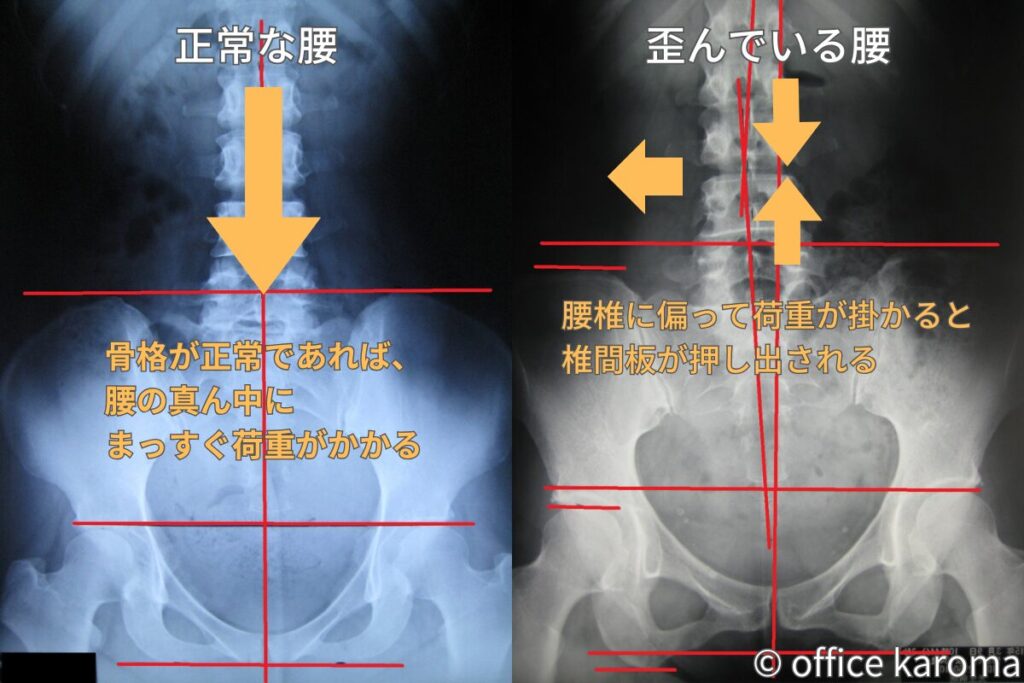 腰椎椎間板ヘルニアのレントゲン