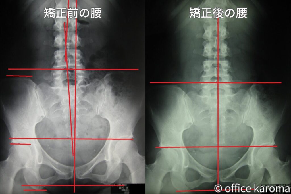 矯正後の骨盤