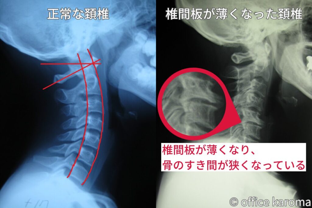 椎間板が薄くなった首のレントゲン