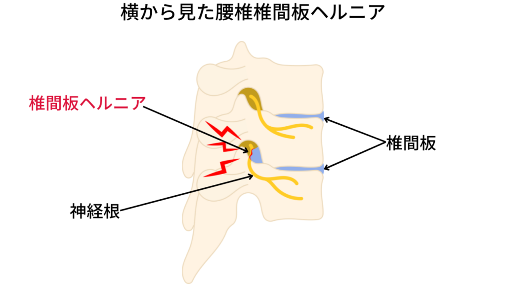 横から見た腰椎椎間板ヘルニアのイラスト