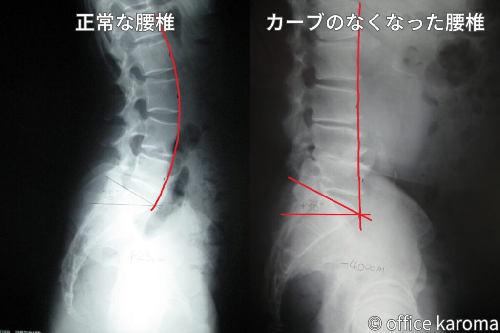 カーブがなくなった腰椎のレントゲン